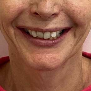 Before Invisalign treatment