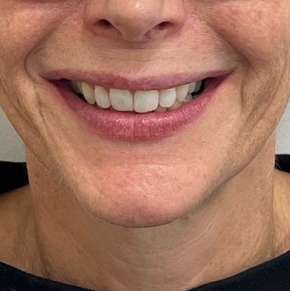 After Invisalign treatment